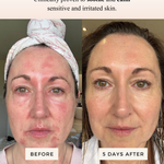 Mud Organics Sea Buckthorn Serum clinical redness before and after