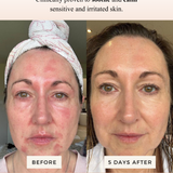 Mud Organics Sea Buckthorn Serum clinical redness before and after