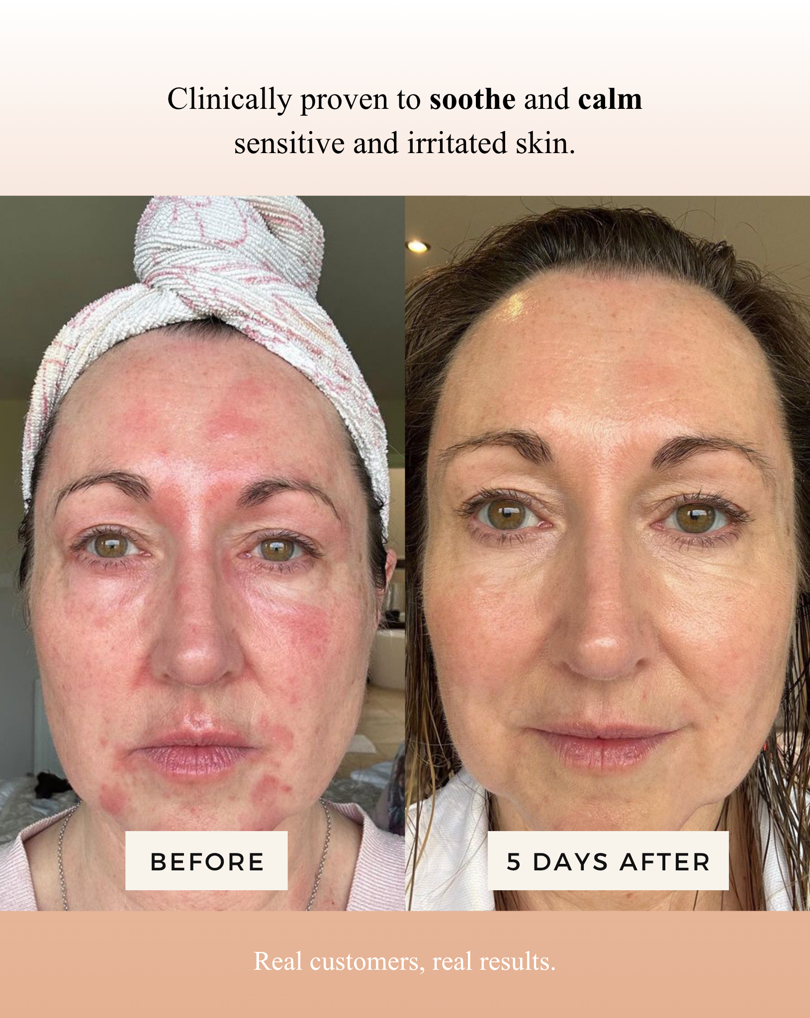 Mud Organics Sea Buckthorn Serum clinical redness before and after