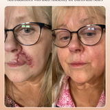 Mud Organics Sea Buckthorn Serum healing before and after