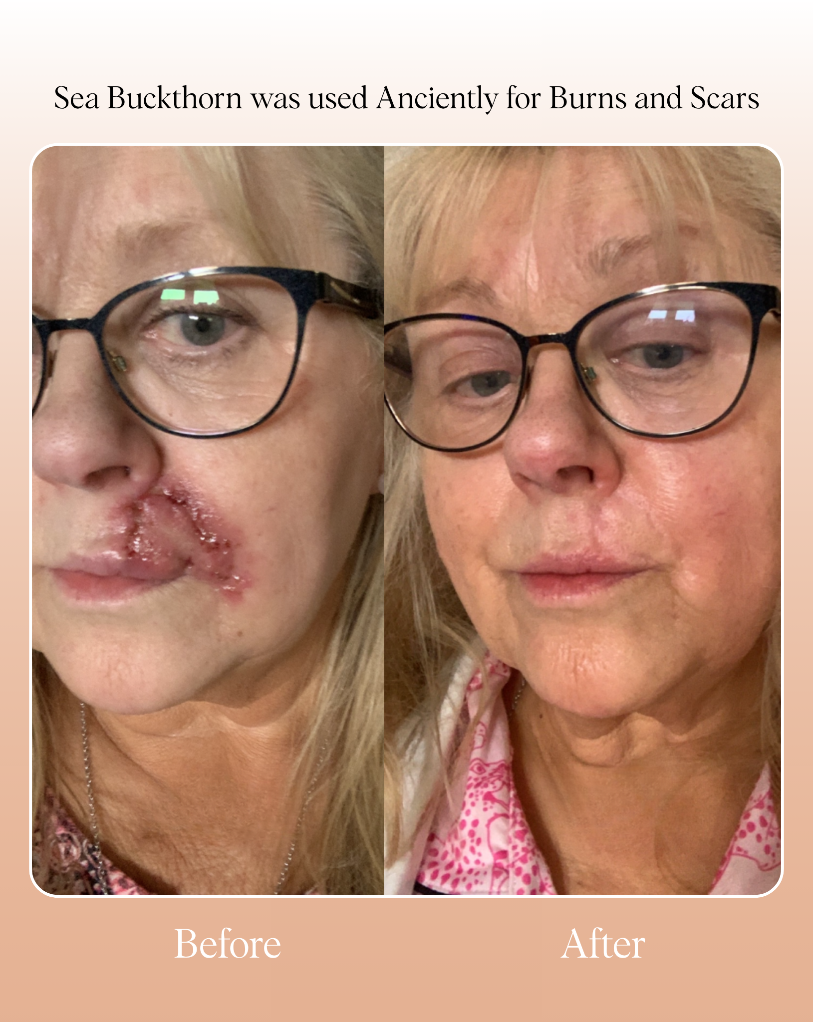 Mud Organics Sea Buckthorn Serum healing before and after