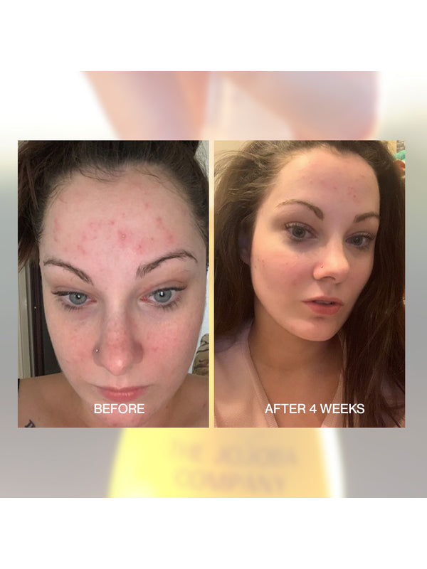 Before and after skin comparison over four weeks using The Jojoba Company Australian Jojoba