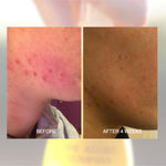 Before and after shoulder skin comparison using The Jojoba Company Australian Jojoba