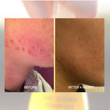 Before and after shoulder skin comparison using The Jojoba Company Australian Jojoba
