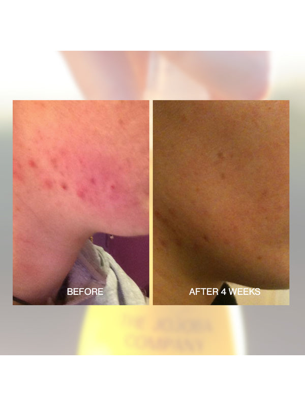 Before and after shoulder skin comparison using The Jojoba Company Australian Jojoba