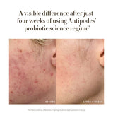 Before and after results from four weeks of Antipodes Credo Probiotic Anti-Blemish Serum