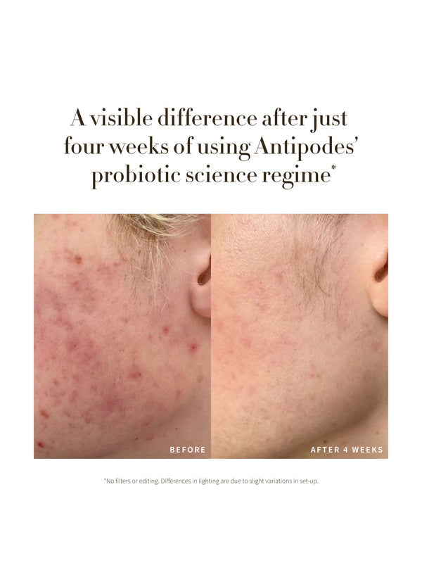 Before and after results from four weeks of Antipodes Credo Probiotic Anti-Blemish Serum