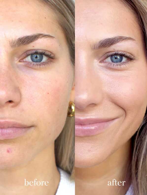 Close-up of a woman’s face split in half: the left side (before) shows pores and blemishes, while the right (after using Ere Perez Arnica All-Cover Pot 5g) reveals clearer, smoother skin and a slight smile.