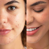 Side-by-side close-up of a woman’s face labeled before and after. Before: visible acne and redness; after: smoother, clearer skin—thanks to Ere Perez Arnica All-Cover Pot 5g cream concealer with buildable coverage—as she smiles, eyes closed.