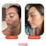 Side-by-side photos show a woman’s acne and redness visibly reduced after six months of using Tuttofare Roman Blue Tallow Balm 70g. Left image labeled “before,” right image “6 months later” with clearer, smoother skin.