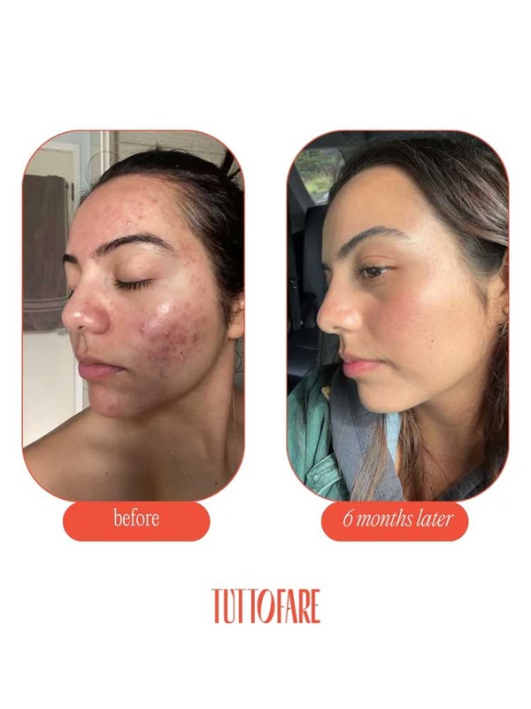 Side-by-side photos show a woman’s acne and redness visibly reduced after six months of using Tuttofare Roman Blue Tallow Balm 70g. Left image labeled “before,” right image “6 months later” with clearer, smoother skin.