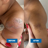 MooGoo Mini Moo Baby Eczema & Psoriasis Cream 120g — official MooGoo clinical before-and-after image 6