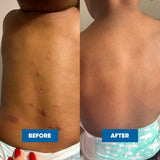 MooGoo Mini Moo Baby Eczema & Psoriasis Cream 120g — official MooGoo clinical before-and-after image 3