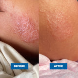 MooGoo Mini Moo Baby Eczema & Psoriasis Cream 120g — official MooGoo clinical before-and-after image 2