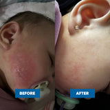 MooGoo Eczema & Psoriasis Cream 200g — official MooGoo clinical before-and-after image 3