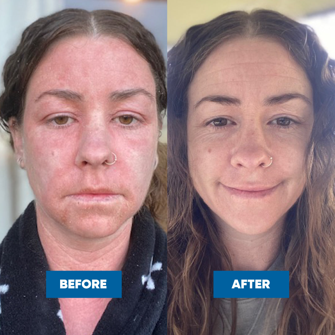 MooGoo Pink Eczema Cream 120g clinical results