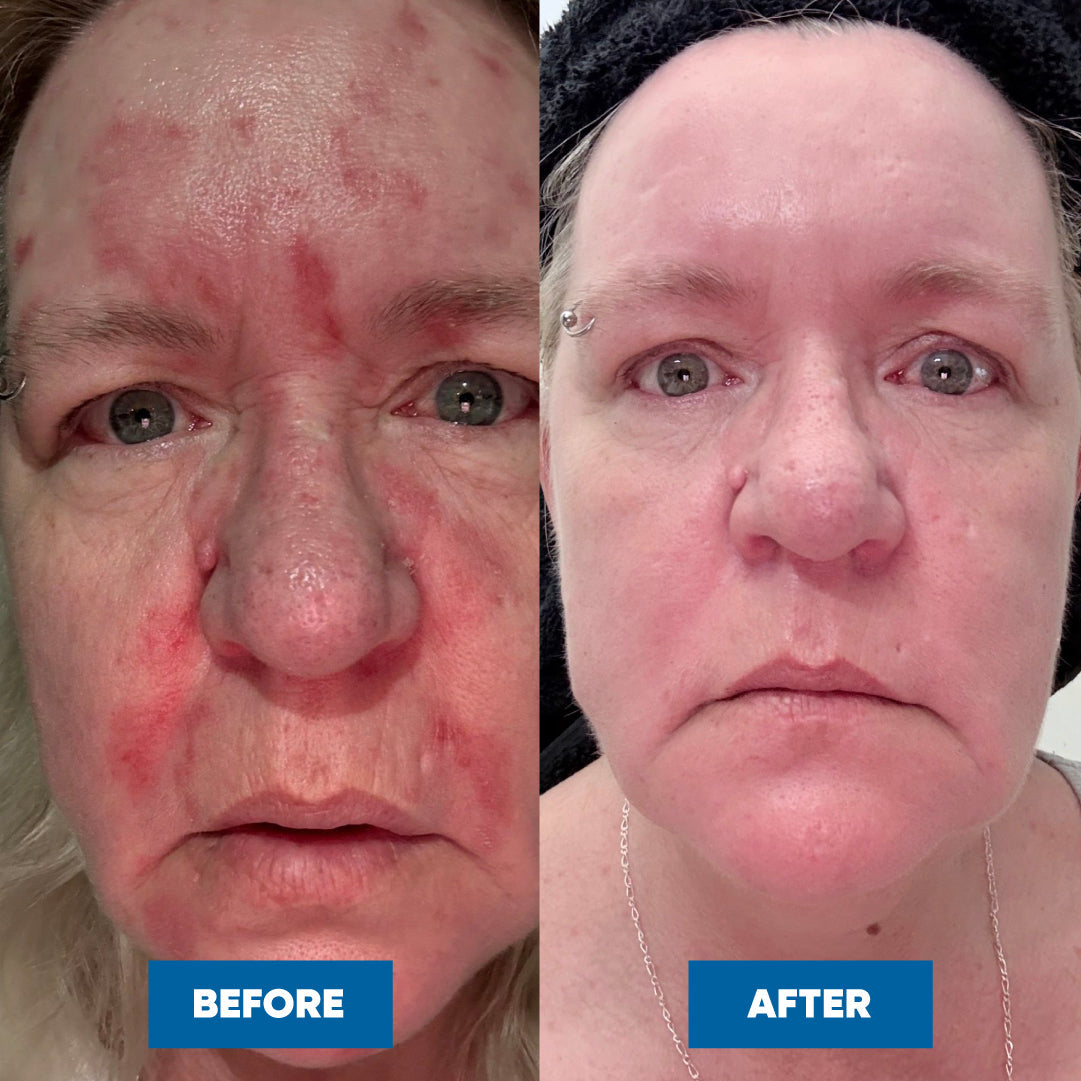 MooGoo Eczema & Psoriasis Cream with Marshmallow, Elderberry & More — official MooGoo clinical before-and-after image 4