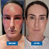 MooGoo Mini Moo Baby Eczema & Psoriasis Cream 120g — official MooGoo clinical before-and-after image 4