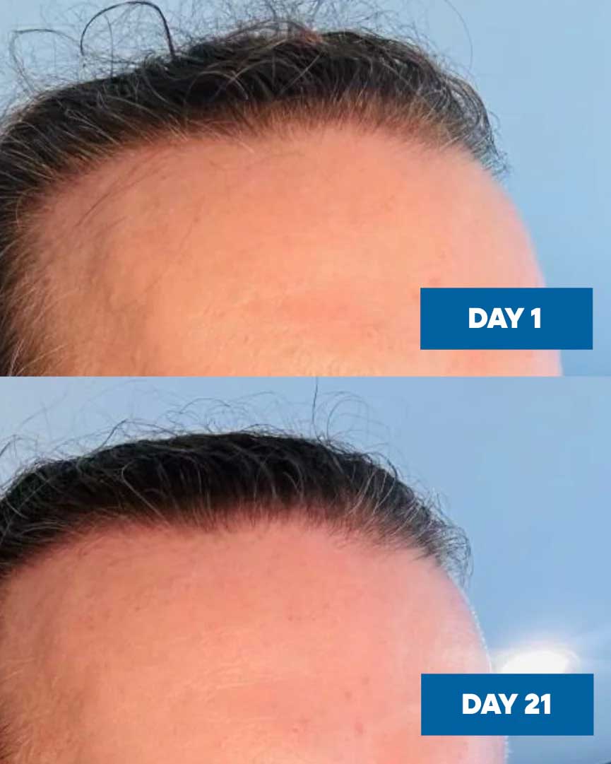 Close-up of a forehead shows hair growth progress with MooGoo Hair Growth Serum 30ml: Day 1 reveals a receding hairline, while Day 21 displays noticeably thicker hair along the hairline, suggesting visible results.