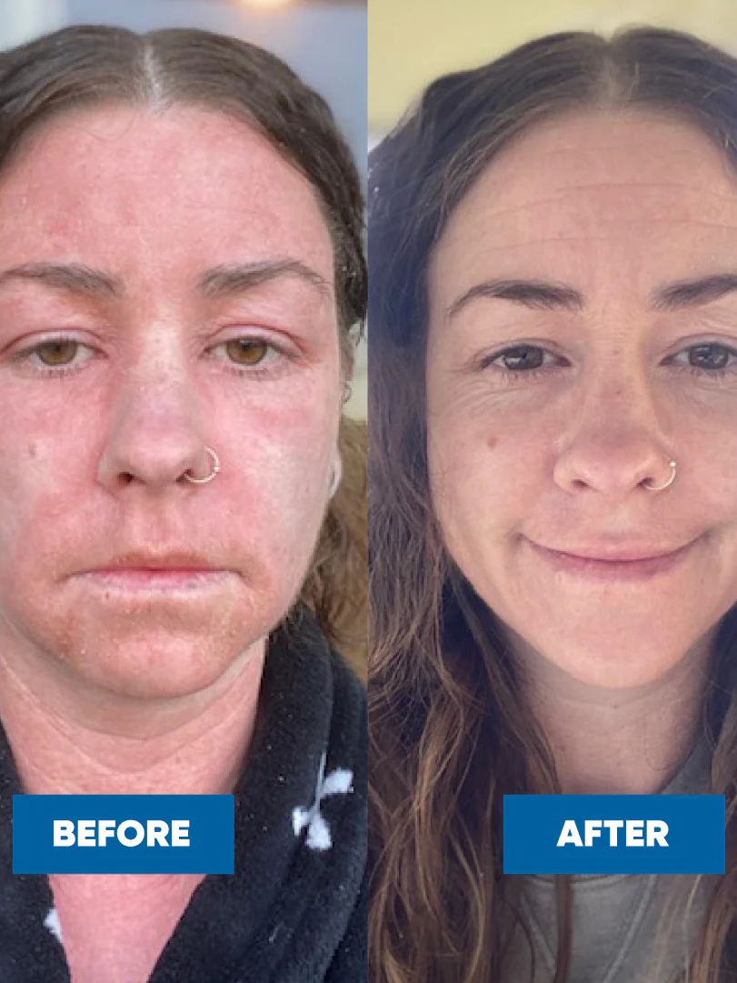 Side-by-side photos of a woman with long brown hair and a nose ring. The left photo shows red, irritated skin; the right, after using MooGoo Pink Eczema Cream 120g, shows clearer, healthier-looking skin and a slight smile.