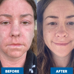 Side-by-side photos of a woman with long brown hair and a nose ring. The left photo shows red, irritated skin; the right, after using MooGoo Pink Eczema Cream 120g, shows clearer, healthier-looking skin and a slight smile.