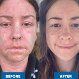 Side-by-side photos of a woman with long brown hair and a nose ring. The left photo shows red, irritated skin; the right, after using MooGoo Pink Eczema Cream 120g, shows clearer, healthier-looking skin and a slight smile.