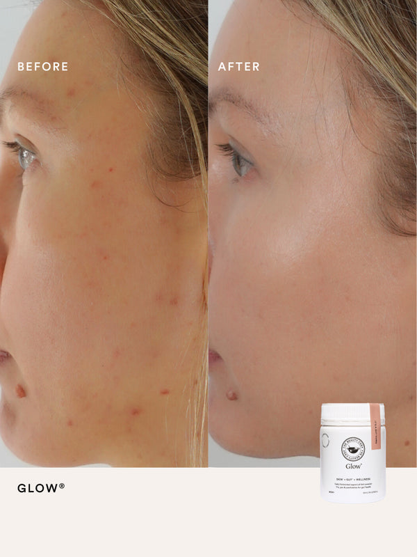Third before and after comparison using The Beauty Chef Glow