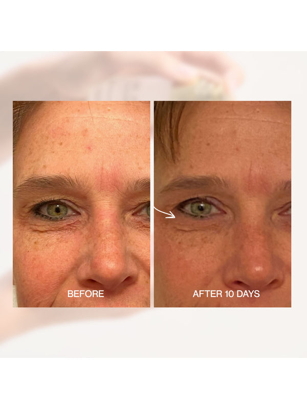 Before and after eye area comparison after ten days using The Jojoba Company Ultimate Serum