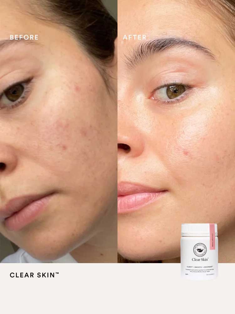 Close-up split image of a woman's face shows before and after results on blemish-prone skin. The after side appears clearer and smoother thanks to The Beauty Chef Clear Skin™ Berry 150g powder. A jar is placed in the corner.