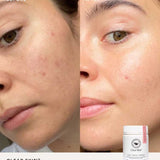 Close-up split image of a woman's face shows before and after results on blemish-prone skin. The after side appears clearer and smoother thanks to The Beauty Chef Clear Skin™ Berry 150g powder. A jar is placed in the corner.