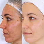 Before and after pigmentation results from the Vanessa Megan Holy Trinity routine