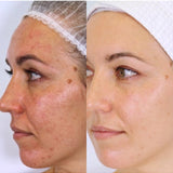 Before and after pigmentation results from the Vanessa Megan Holy Trinity routine
