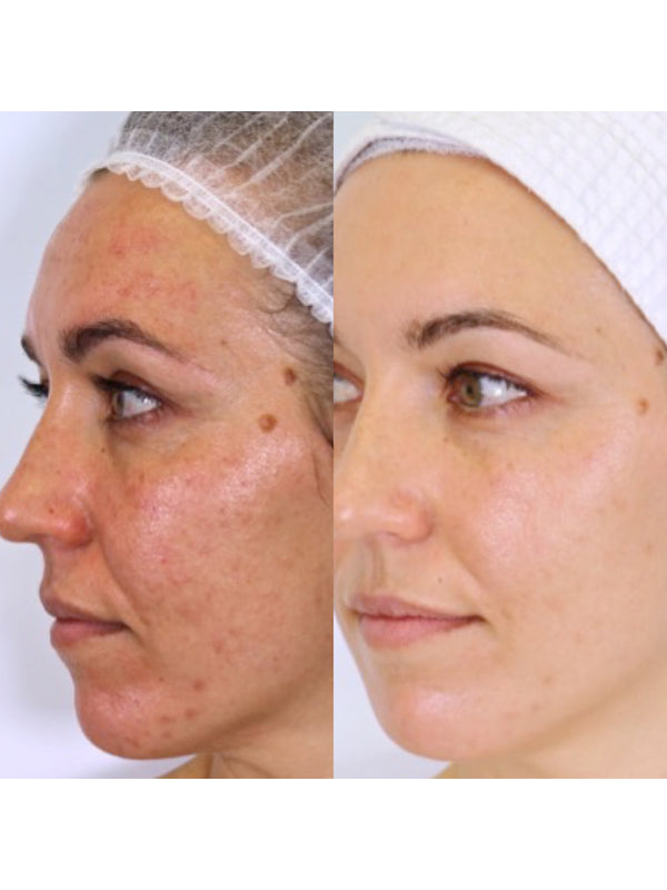 Before and after pigmentation results from the Vanessa Megan Holy Trinity routine