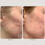 Zilch Acne Formula