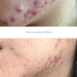 Zilch Acne Formula