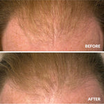 Before and after hair density result using A bit Hippy Hair Growth Serum