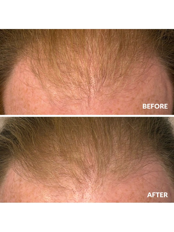 Before and after hair density result using A bit Hippy Hair Growth Serum