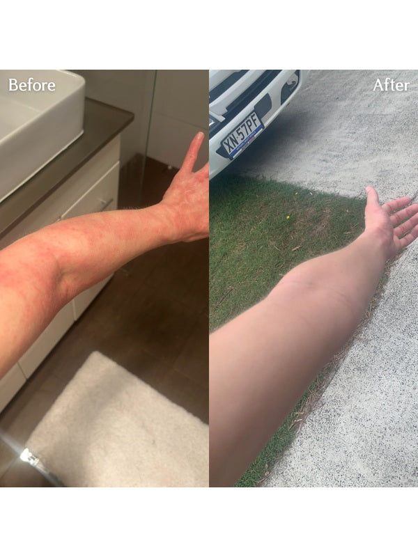 Before and after skin results using Calm Tallow Balm – Thrive Tallow Calm Tallow Balm 100ml