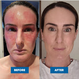 Two face photos labelled Before and After, showing pronounced redness across the forehead and cheeks on the left and less visible redness on the right.