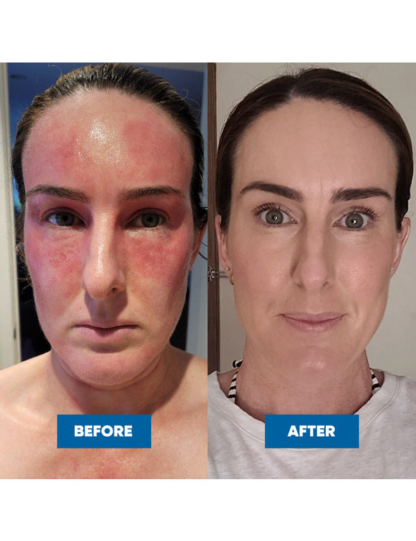 Two face photos labelled Before and After, showing pronounced redness across the forehead and cheeks on the left and less visible redness on the right.