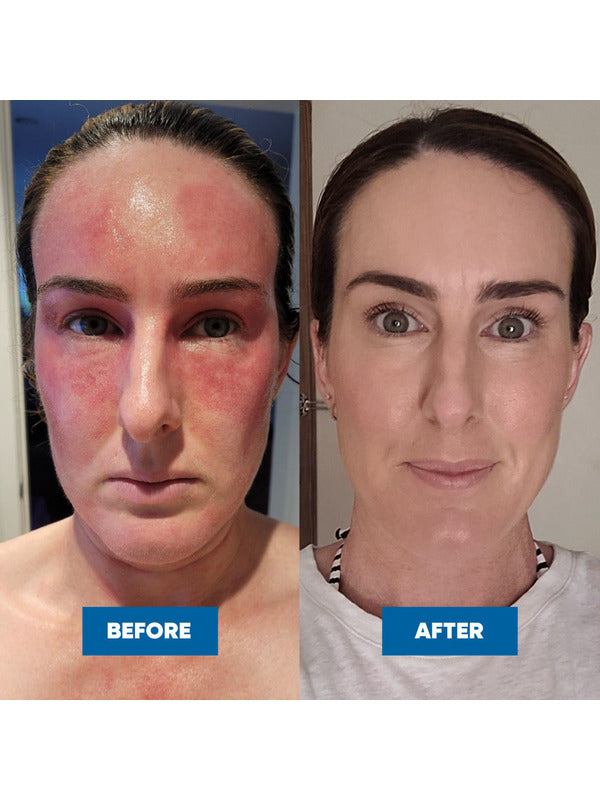 Two face photos labelled Before and After, showing pronounced redness across the forehead and cheeks on the left and less visible redness on the right.
