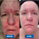 Side-by-side close-up face photos labelled Before and After, showing red, patchy facial skin before using MooGoo Eczema & Psoriasis Cream and calmer, more even-looking skin after use.