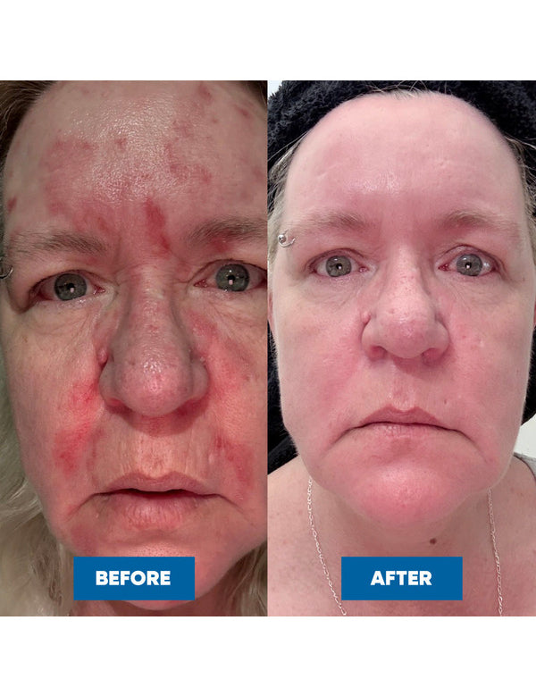 Side-by-side close-up face photos labelled Before and After, showing red, patchy facial skin before using MooGoo Eczema & Psoriasis Cream and calmer, more even-looking skin after use.