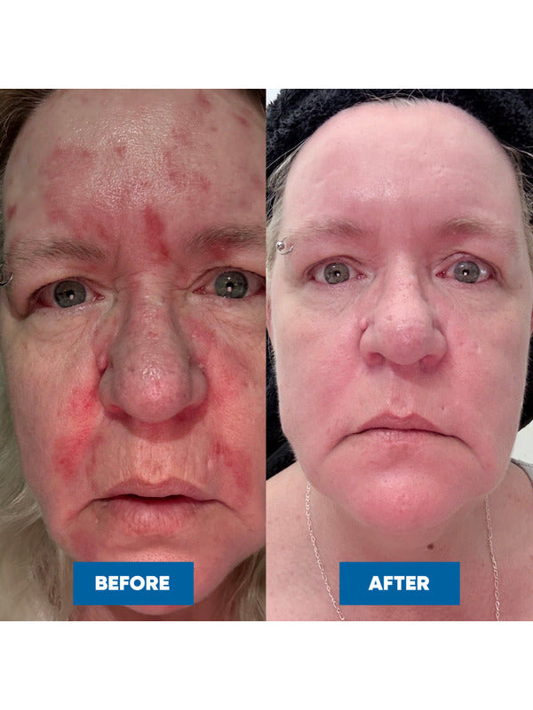 Side-by-side close-up face photos labelled Before and After, showing red, patchy facial skin before using MooGoo Eczema & Psoriasis Cream and calmer, more even-looking skin after use.