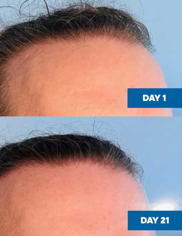 Two-panel MooGoo Hair Growth Serum comparison showing the hairline at Day 1 and visibly fuller-looking hair at Day 21.