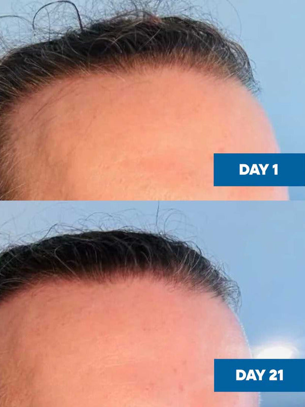 Two-panel MooGoo Hair Growth Serum comparison showing the hairline at Day 1 and visibly fuller-looking hair at Day 21.
