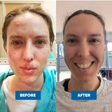 Two face photos labelled Before and After, showing red, blotchy skin across the forehead, cheeks and mouth area on the left and less visible redness on the smiling face on the right.