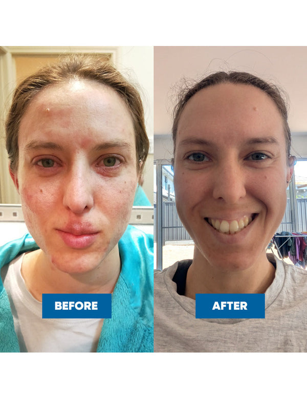 Two face photos labelled Before and After, showing red, blotchy skin across the forehead, cheeks and mouth area on the left and less visible redness on the smiling face on the right.