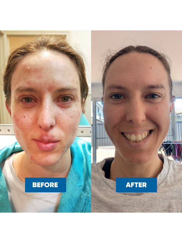 Two face photos labelled Before and After, showing red, blotchy skin across the forehead, cheeks and mouth area on the left and less visible redness on the smiling face on the right.