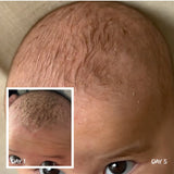 Close-up of a baby's scalp labelled Day 5, with a Day 1 inset showing thicker yellowish crusts along the front of the scalp.